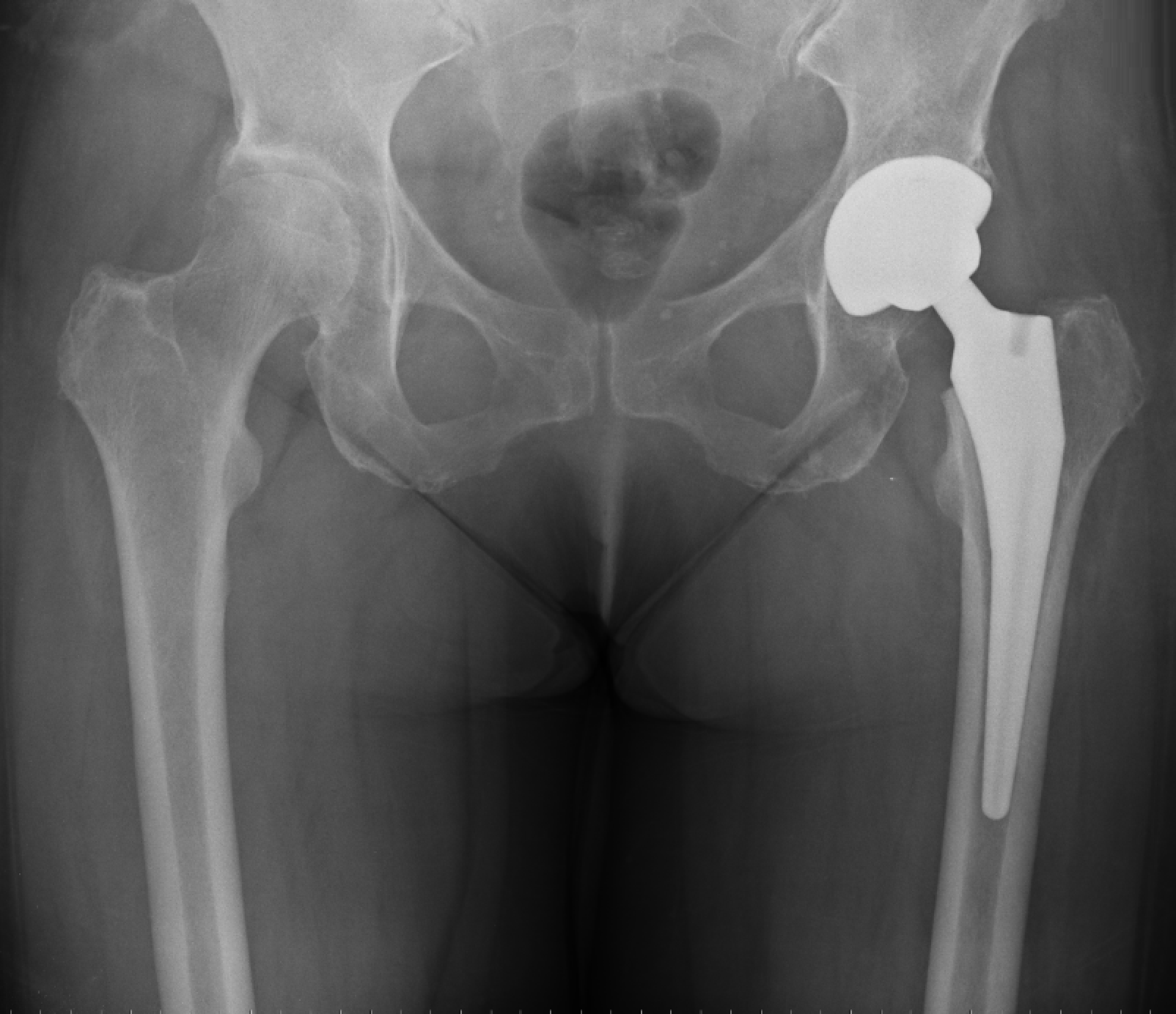 Hip Rast Hip Arthritis (Hip Osteoarthritis)
